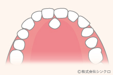 過剰歯の抜歯