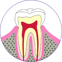 虫歯の進行段階　C4　歯根まで達したむし歯